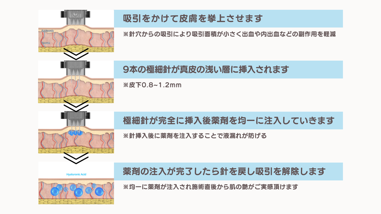 水光注射 (トライフィルプロ) | 毛穴 | さっぽろ美容クリニック円山院