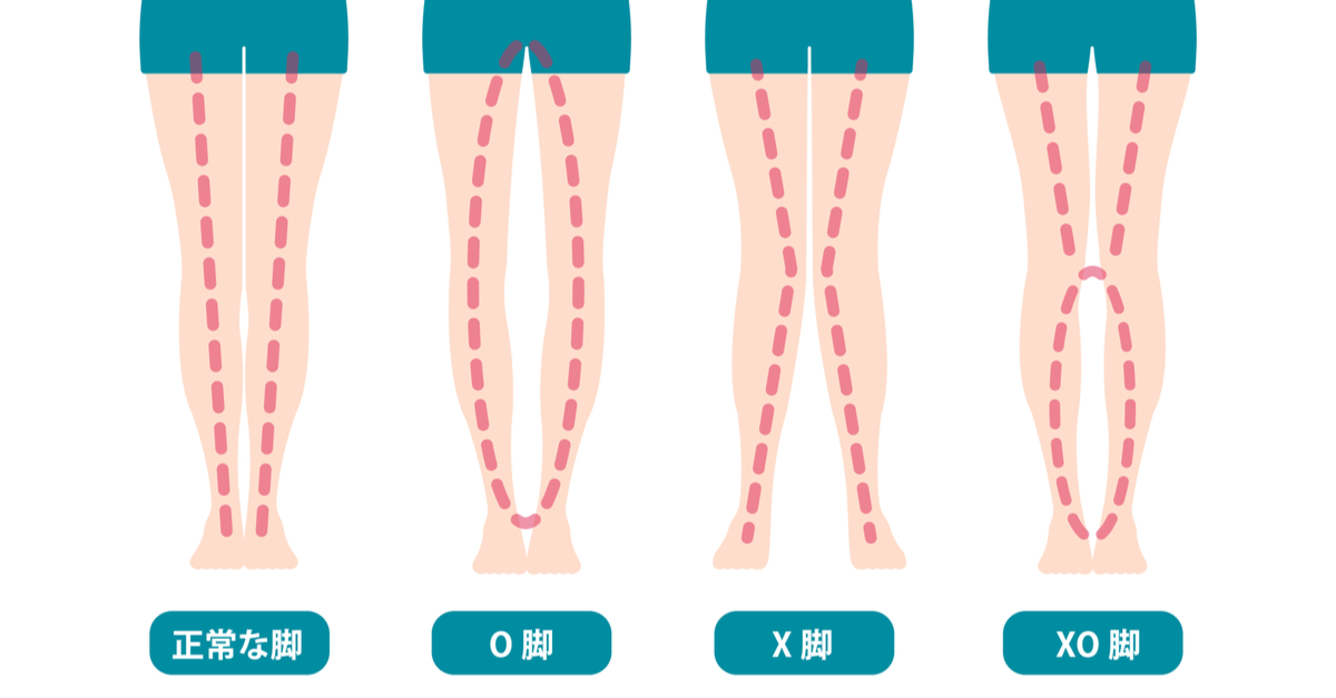 O脚を治せば身長が伸びる？原因・改善方法とおすすめグッズ4選！ ｜ Rolmy
