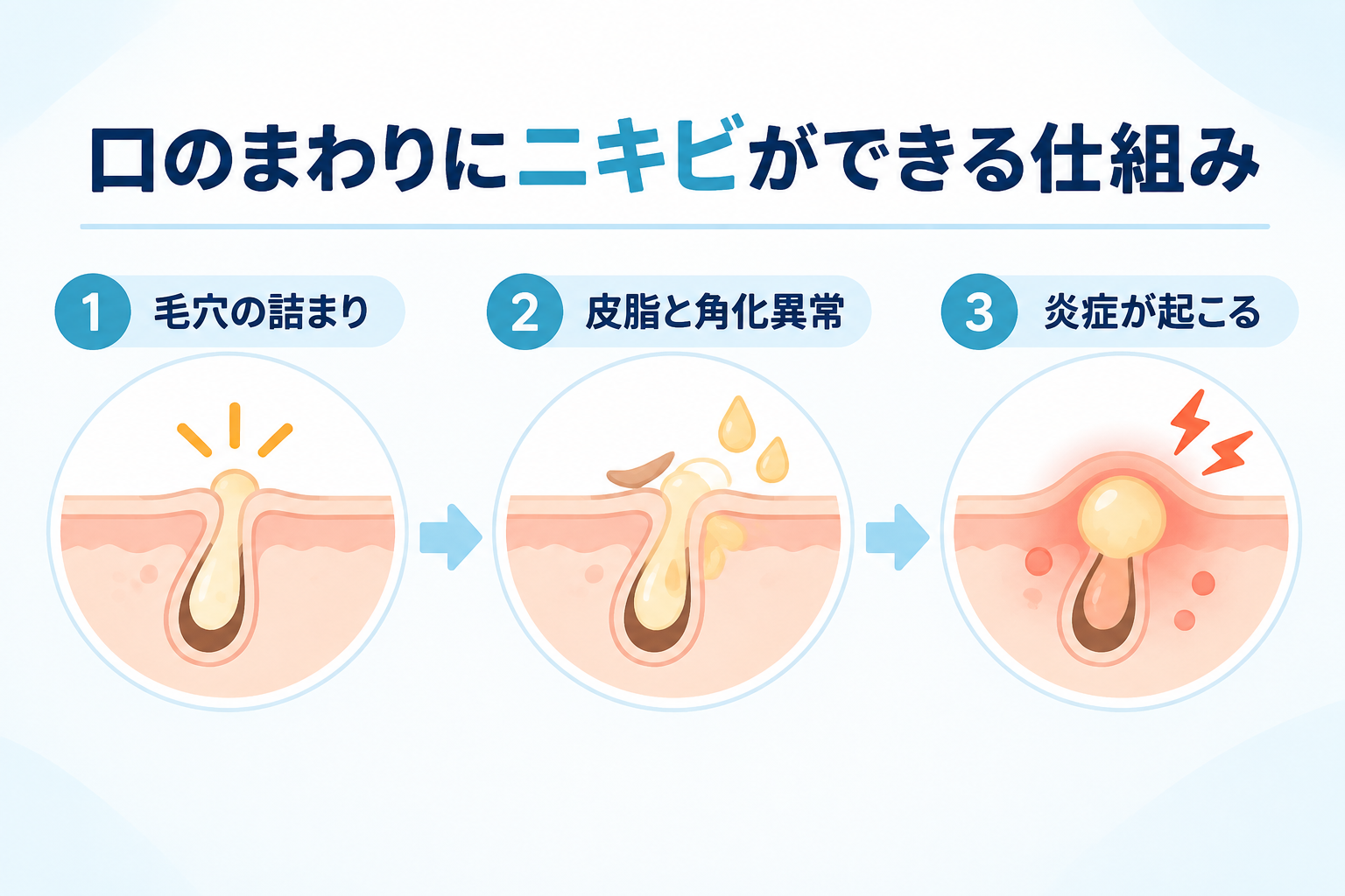 口のまわりにニキビができる仕組み|毛穴の詰まり|皮脂と角化異常|炎症が起こる