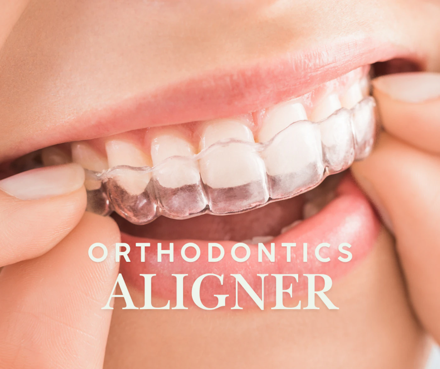 マウスピース矯正はどんな人に向いてる？歯科医が教える適応症と注意点