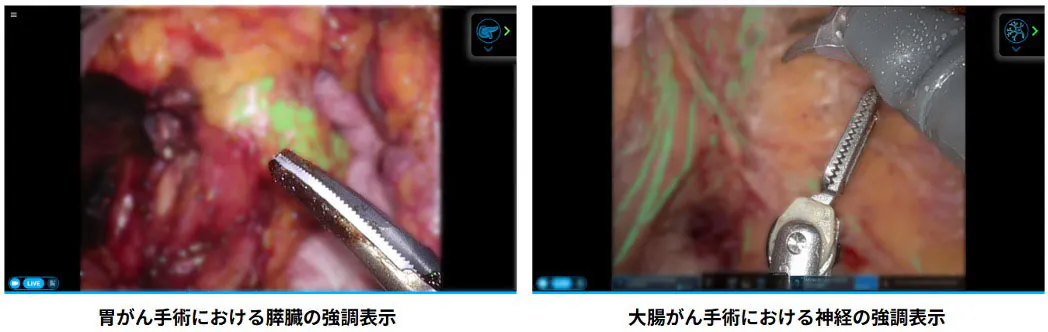 「EUREKA α」で該当組織を緑色で強調表示している様子。組織をピクセルレベルで認識・表示することが可能(画像:ぼかし加工済)