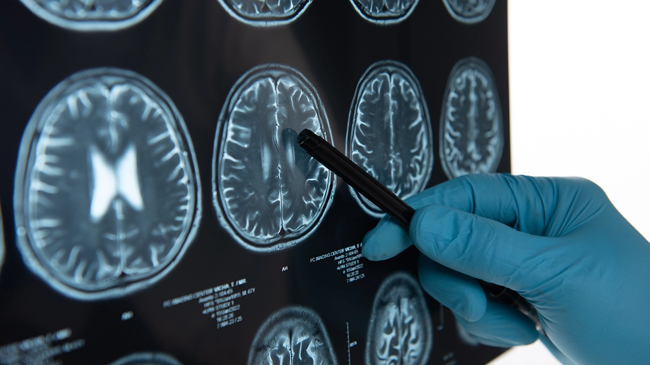 脳血管内治療の新たな標準へ──N.B.Medical、8.5億円で臨床試験準備を加速