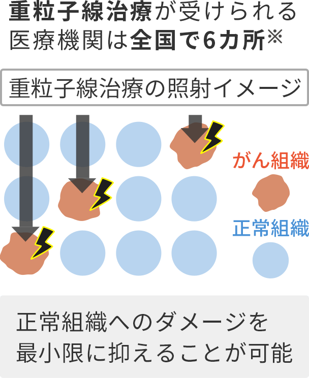 図2 重粒子線治療の照射イメージ