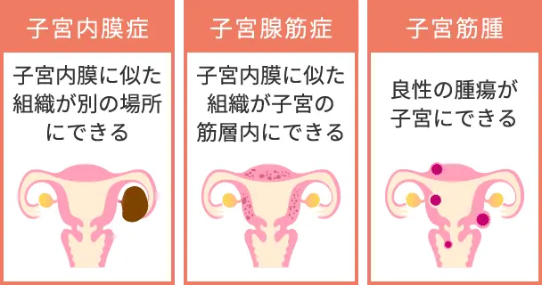 図1　子宮の病気の例のイメージ