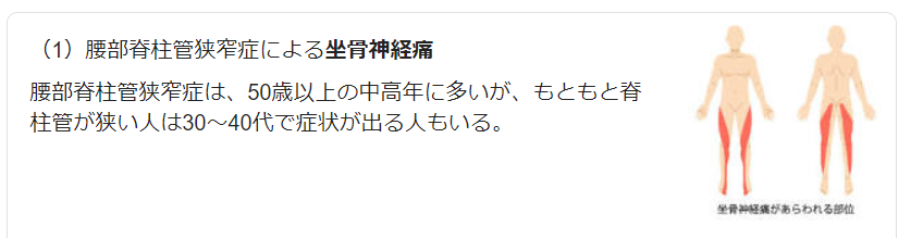 坐骨神経痛についてのWeb検索結果