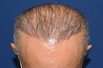 50代 男性 T.M.さん 生え際・前頭部 自毛植毛（MIRAI法）1,500株の症例（術後6ヶ月の経過）