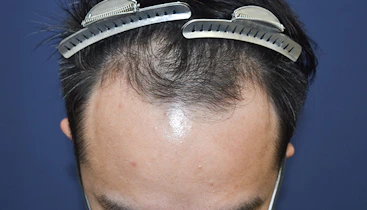 30代 男性 K.T.さん 生え際・頭頂部・つむじ 自毛植毛（MIRAI法）3,000株の症例｜自毛植毛の症例（手術前）