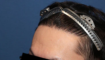 30代 男性 S.K.さん 生え際 前頭部 自毛植毛（MIRAI法）1,700株の症例｜自毛植毛の症例（手術後）