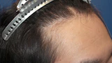 20代 男性  K.G.さん 生え際 自毛植毛（MIRAI法）1,600株の症例｜自毛植毛の症例（手術後）