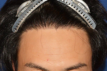 30代 男性 H.T.さん 生え際 自毛植毛（MIRAI法）1,500株の症例｜自毛植毛の症例（術後1年の経過）