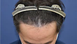 40代 男性 H.S.さん 生え際 自毛植毛（MIRAI法）1,600株の症例｜自毛植毛の症例（手術後）