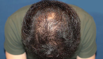 40代 男性 N.T.さん 前頭部・頭頂部 自毛植毛（MIRAI法）3,000株の症例｜自毛植毛の症例（2回目手術から4ヶ月後）