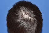 30代 男性 W.Y.さん 前頭部・頭頂部 自毛植毛（MIRAI法）2,700株の症例｜自毛植毛の症例（手術後）