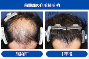 30代 男性 S.T.さん／前頭部～頭頂部 自毛植毛（MIRAI法）／1,500株の症例