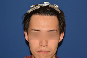 20代 男性 S.T.さん 生え際 自毛植毛（MIRAI法） 2,000株の症例｜自毛植毛の症例（手術後）