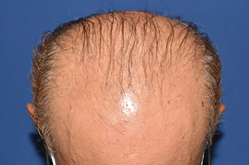 50代 男性 T.M.さん 生え際・前頭部 自毛植毛（MIRAI法）1,500株の症例｜自毛植毛の症例（手術前）