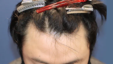30代 男性 Y.Y.さん 生え際・つむじ 自毛植毛（MIRAI法）1,000株の症例｜自毛植毛の症例（手術前）