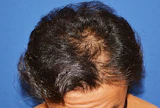 40代 男性 I.M.さん 生え際・頭頂部 自毛植毛（MIRAI法）1,500株の症例｜自毛植毛の症例（手術前）
