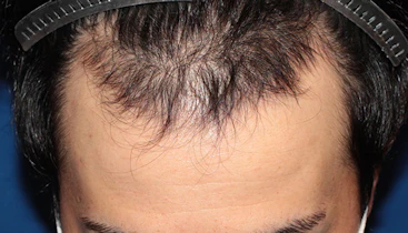 20代 男性 Y.A.さん 生え際 自毛植毛（MIRAI法）1,500株の症例｜自毛植毛の症例（手術前）