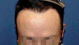 40代 男性  K.S.さん 生え際 自毛植毛（MIRAI法）1,500株の症例｜自毛植毛の症例（手術後）