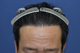 40代 男性 I.S.さん 生え際・前頭部・右こめかみ自毛植毛（MIRAI法）2,800株の症例｜自毛植毛の症例（手術後）