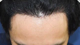 20代 男性 N.S.さん 生え際 自毛植毛（MIRAI法）1,500株の症例｜自毛植毛の症例（手術後）