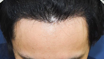 20代 男性 N.S.さん 生え際 自毛植毛（MIRAI法）1,500株の症例｜自毛植毛の症例（手術後）