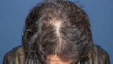 40代 男性 N.T.さん 生え際・前頭部・頭頂部 自毛植毛（MIRAI法）3,000株の症例｜自毛植毛の症例（2回目手術後）