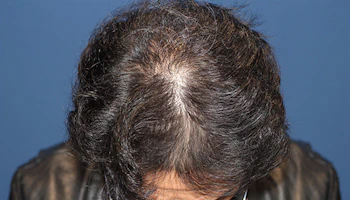40代 男性 N.T.さん 前頭部・頭頂部 自毛植毛（MIRAI法）3,000株の症例｜自毛植毛の症例（2回目手術から1年後）
