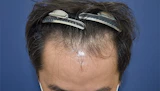 40代 男性 H.S.さん 生え際 自毛植毛（MIRAI法）1,600株の症例｜自毛植毛の症例（手術前）