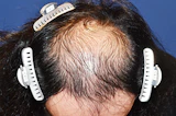 30代 男性 S.T.さん 前頭部～頭頂部 自毛植毛（MIRAI法）1,500株の症例｜自毛植毛の症例（手術前）