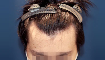 20代 男性 K.S.さん 前頭部 自毛植毛（MIRAI法）1,600株の症例｜自毛植毛の症例（手術前）