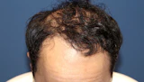 30代 男性 K.K.さん 生え際 自毛植毛（MIRAI法）3,000株の症例｜自毛植毛の症例（手術後）