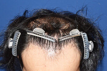 30代 男性 S.T.さん 前頭部～頭頂部 自毛植毛（MIRAI法）1,500株の症例｜自毛植毛の症例（術後6ヶ月）