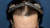 30代 男性 A.K.さん 生え際 自毛植毛（MIRAI法）1,000株の症例｜自毛植毛の症例（手術後）
