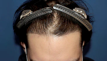 30代 男性 A.K.さん 生え際 自毛植毛（MIRAI法）1,000株の症例｜自毛植毛の症例（手術後）