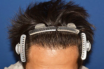 30代 男性 A.Y.さん 生え際 自毛植毛（MIRAI法）1,000株の症例｜自毛植毛の症例（術後6ヶ月）