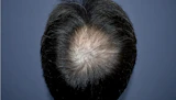 50代 男性 A.Y.さん 頭頂部 自毛植毛（MIRAI法）2,500株の症例｜自毛植毛の症例（手術前）
