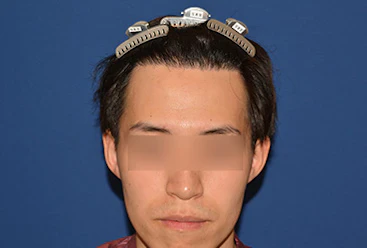 20代 男性 S.T.さん 生え際 自毛植毛（MIRAI法） 2,000株の症例｜自毛植毛の症例（手術後）