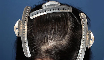 20代 女性 N.S.さん 前頭部 自毛植毛（MIRAI法）1,000株の症例｜自毛植毛の症例（手術後）