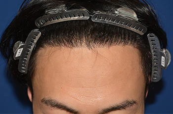 30代 男性 H.T.さん 生え際 自毛植毛（MIRAI法）1,500株の症例｜自毛植毛の症例（術後6ヶ月の経過）