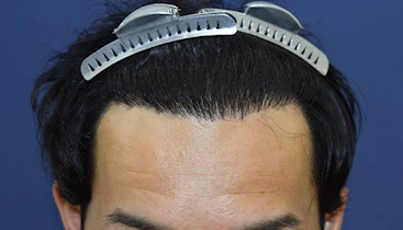 20代 男性 O.K.さん 生え際 自毛植毛（MIRAI法）2,500株の症例｜自毛植毛の症例（手術後）
