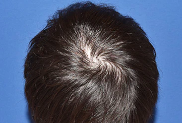30代 男性 W.Y.さん 前頭部・頭頂部 自毛植毛（MIRAI法）2,700株の症例｜自毛植毛の症例（手術後）