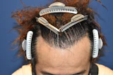 50代 男性 O.N.さん 前頭部 自毛植毛（MIRAI法）2,000株の症例｜自毛植毛の症例（手術後）