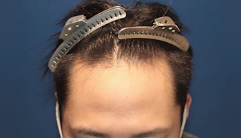 30代 男性 H.H.さん 生え際 自毛植毛（MIRAI法）1,500株の症例｜自毛植毛の症例（手術前：正面）