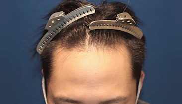 30代 男性 H.H.さん 生え際 自毛植毛（MIRAI法）1,500株の症例｜自毛植毛の症例（手術前）