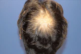 50代 男性 O.Y.さん 頭頂部 自毛植毛（MIRAI法）1,500株の症例｜自毛植毛の症例（手術前）