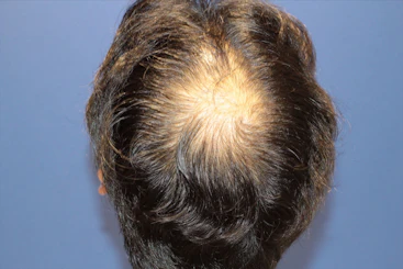 50代 男性 O.Y.さん 頭頂部 自毛植毛（MIRAI法）1,500株の症例｜自毛植毛の症例（手術前）