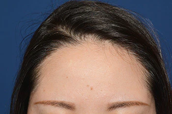 30代 女性 M.A.さん 生え際 自毛植毛（MIRAI法）450株の症例（術後1年経過）