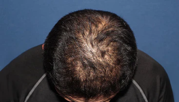 50代 男性 K.T.さん 前頭部・頭頂部 自毛植毛（MIRAI法）2,500株の症例｜自毛植毛の症例（手術後）